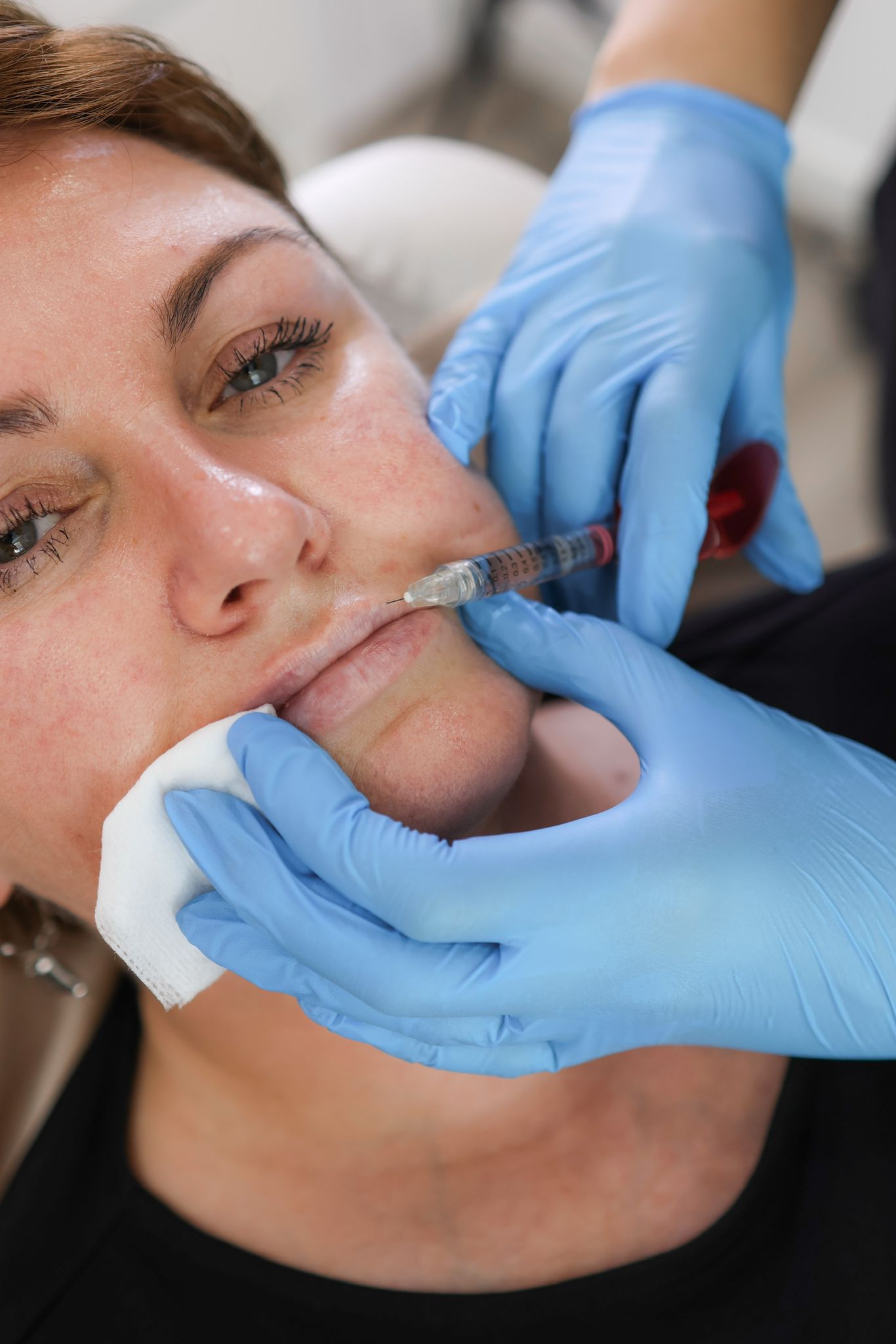 Lip Fillers, Botox, Dermal Fillers, Anti-Wrinkle Injections in Covent Garden WC2